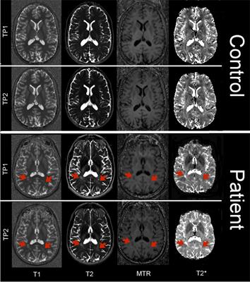 The Combined Quantification and Interpretation of Multiple Quantitative Magnetic Resonance Imaging Metrics Enlightens Longitudinal Changes Compatible with Brain Repair in Relapsing-Remitting Multiple Sclerosis Patients